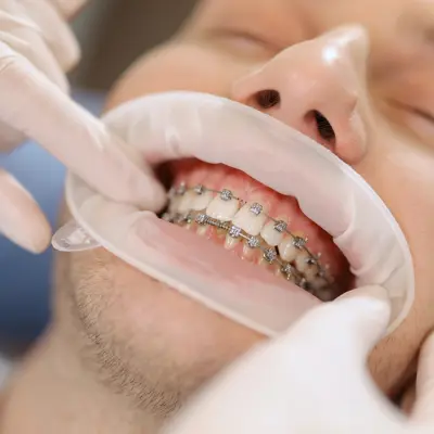 Instalacion de brackets